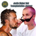Justin Bieber's Hair Transformation: the Journey of His Hair Transplant