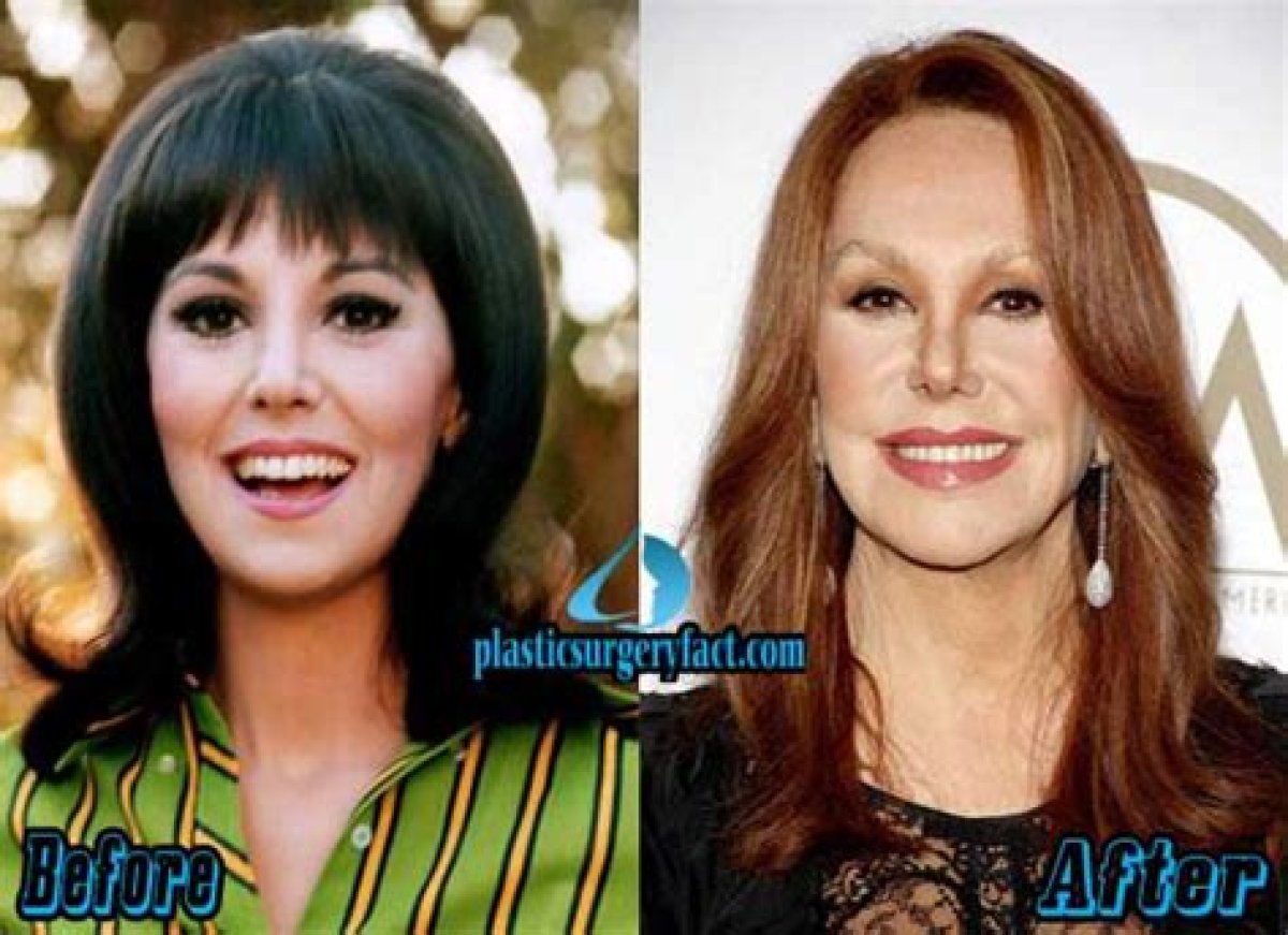 Marlo Thomas Plastic Surgery: a Timeline of Cosmetic Enhancements