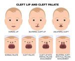 Unbelievable: Celebrities with Cleft Lip and Palate